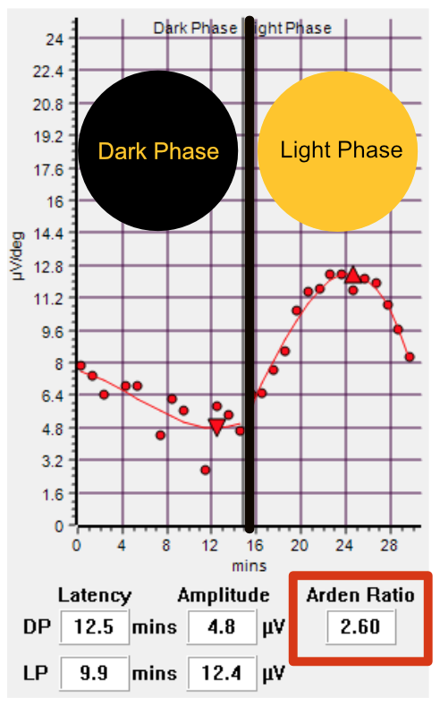 A normal (EOG) electrooculogram response with an Arden Ratio above 2.0.