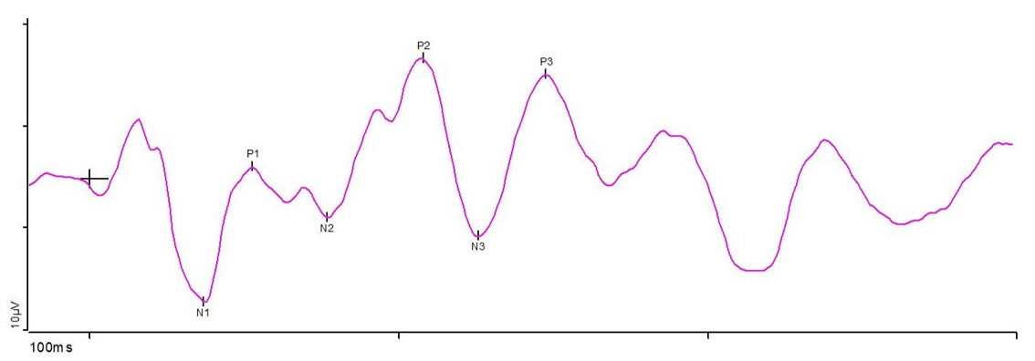 A normal Flash VEP (fVEP) response indicating regular N2 and P2 peaks at 90ms and 120ms, respectively. 