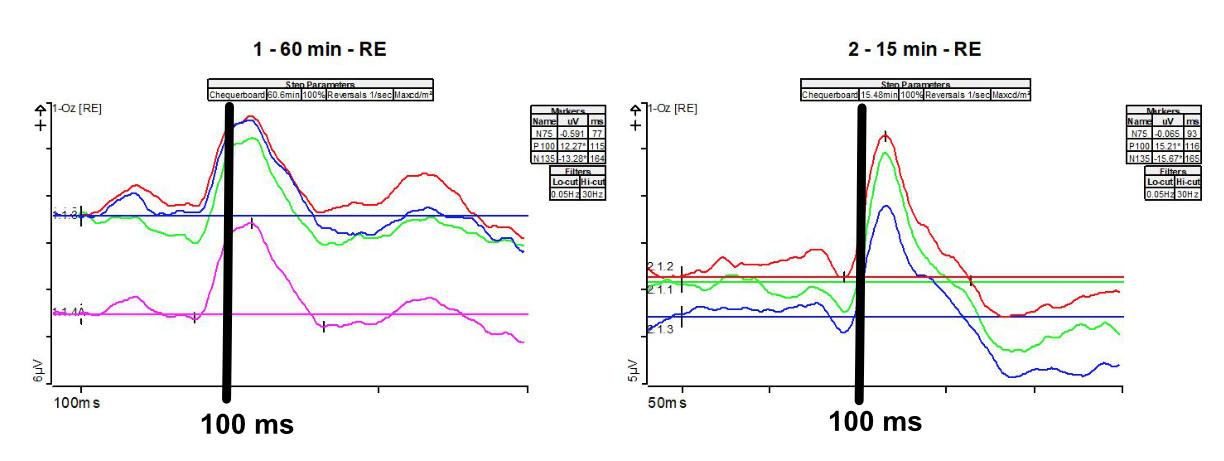 A pattern VEP (pVEP) response from a patient with (MS) multiple sclerosis; a noticable slow down of the P100 peak.