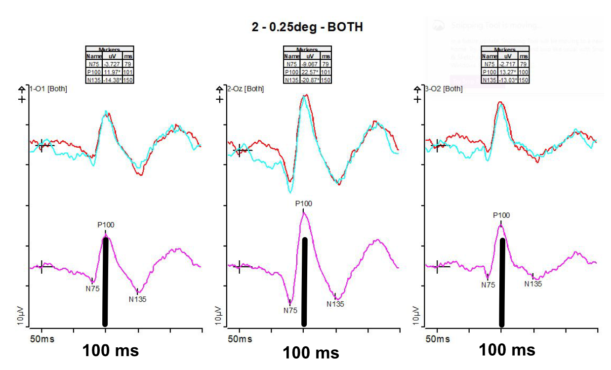 Normal (pVEP) Pattern Visually Evoked Potential with P100 peak at 100ms.