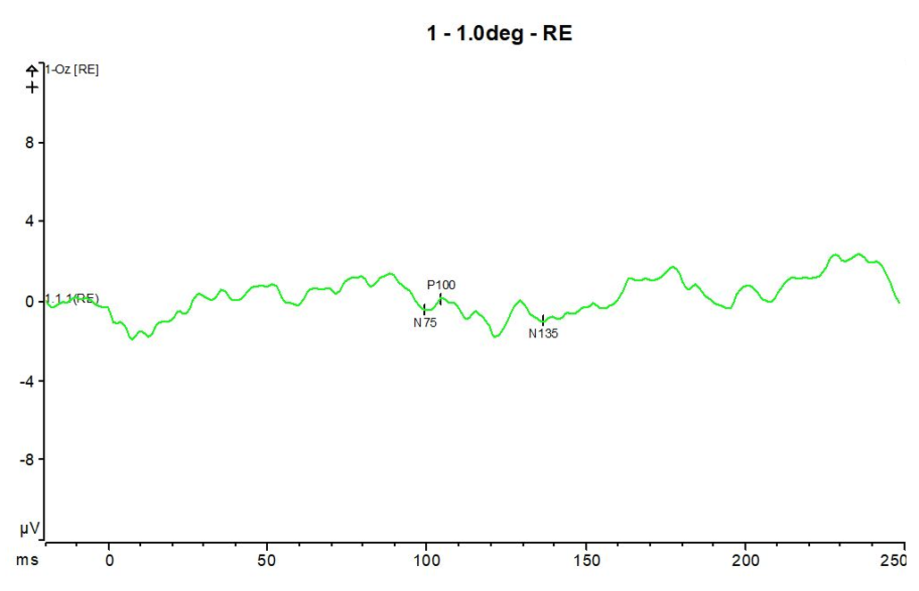 VEP response from a patient with Optic Neuritis, showing a flat waveform morphology. 