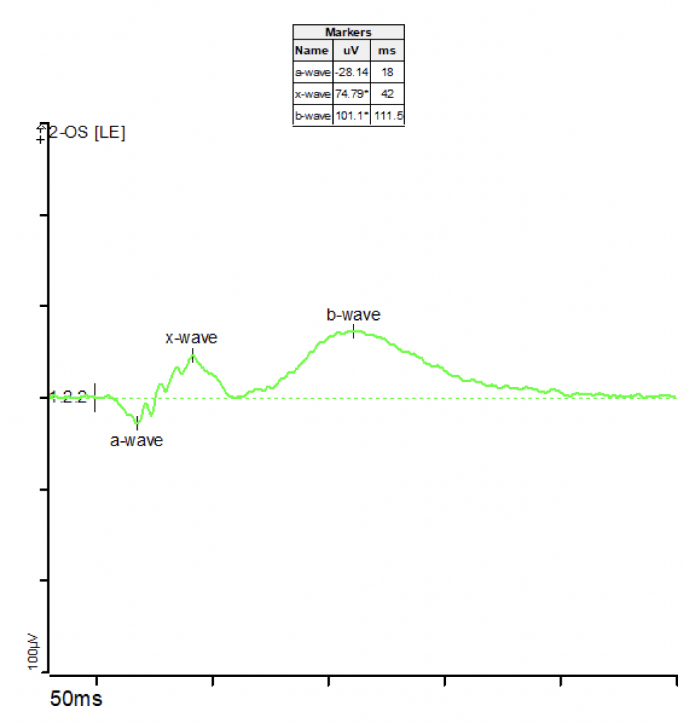 Darkadapted red flash ERG Diagnosys LLC