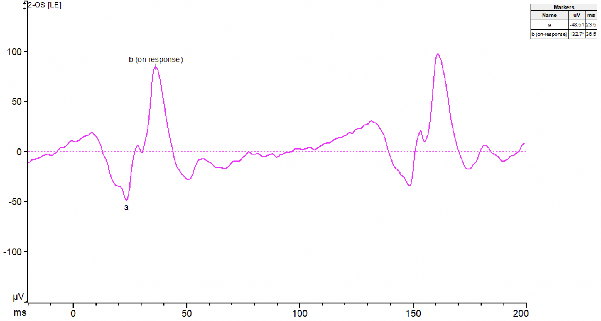 OnOff Electroretinography (onoff ERG) Diagnosys LLC