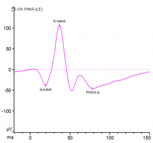 Photopic Negative (PhNR) Response