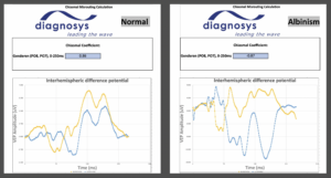 Chiasmal Coefficient for Albinism and Normal Patient Side by Side