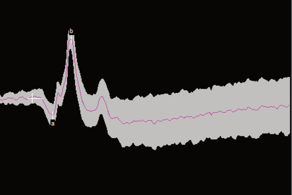 Graph showing the distribution of multiple electroretinography sweeps