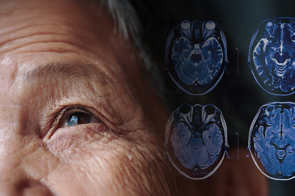An elderly person diagnosed with Parkinson's disease
